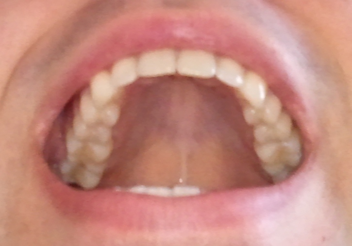 Dents du haut