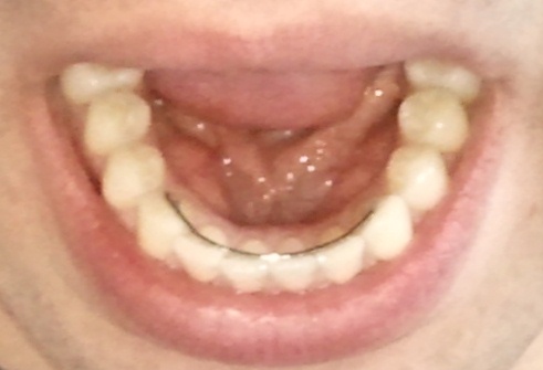 Dents du bas