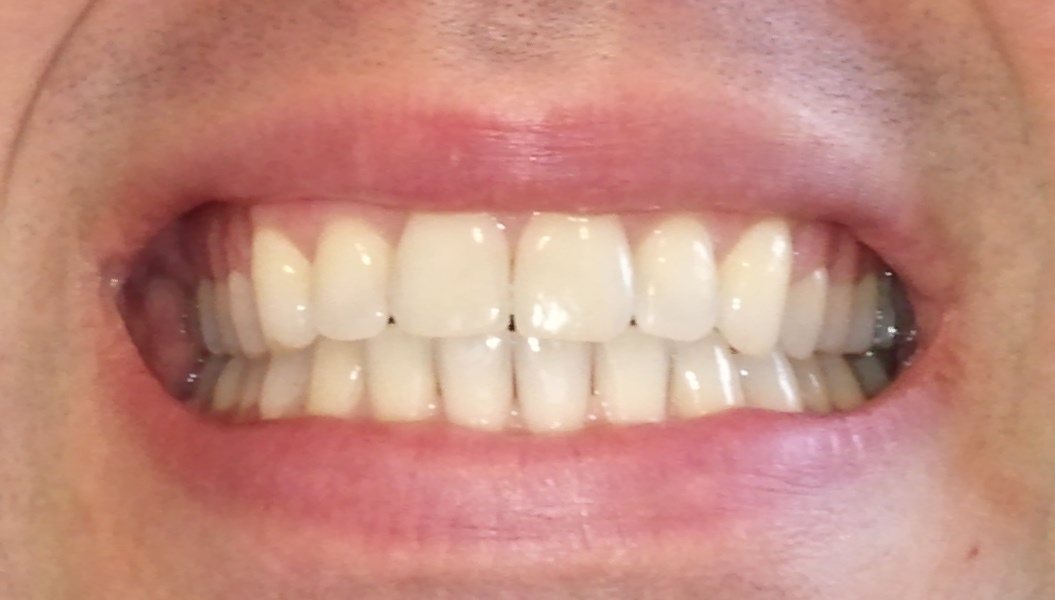 Dents de devant